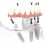 Comparing Types of Dental Implants: All-on-X, Traditional, and Zygomatic Solutions