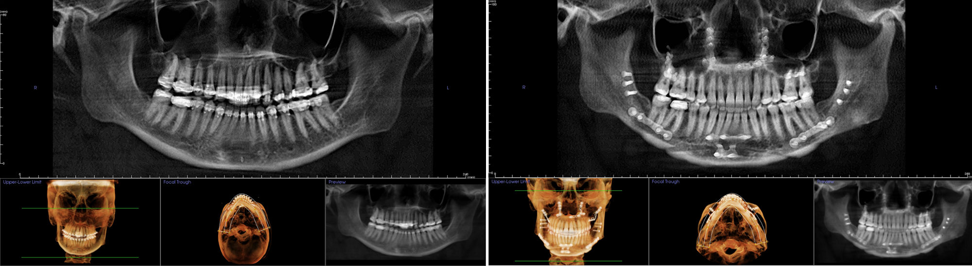OSA-pano-oral-surgery-before-after