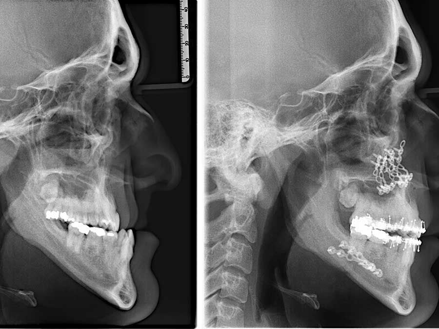 Pediatric TMJ Reconstructions—emerging Research Shows, 45% OFF